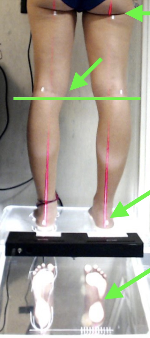 Nella immagine l’analisi della parte adattativa con LED PODO LASER, dalla pianta al bacino